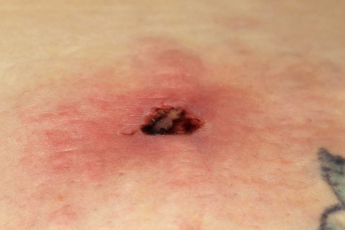 brown recluse spider bite on human skin