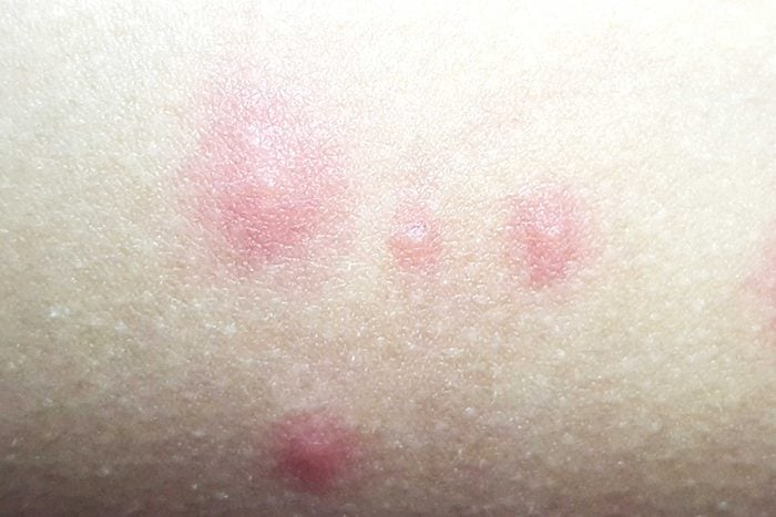 chigger bites on human skin