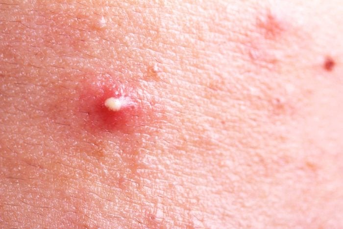 fire ant bites on human skin