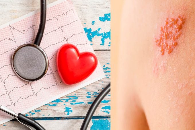 shingles rash, stethoscope and heart ekg