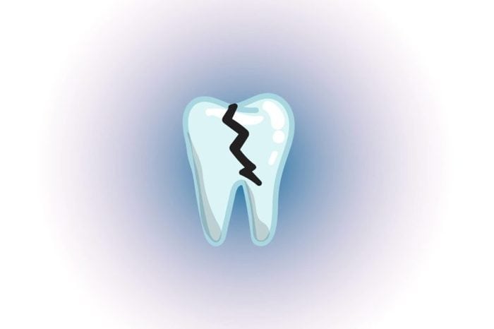 Illustration of a cracked toothl