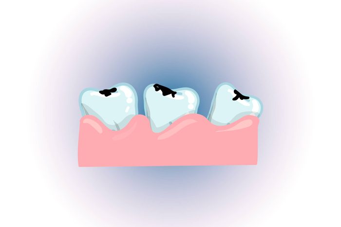 Illustration of three loose teeth in the gum.