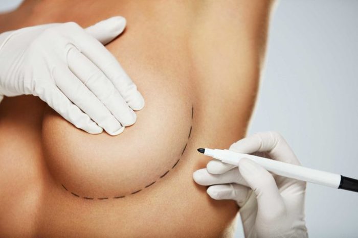 Clinician marking a breast for incision.