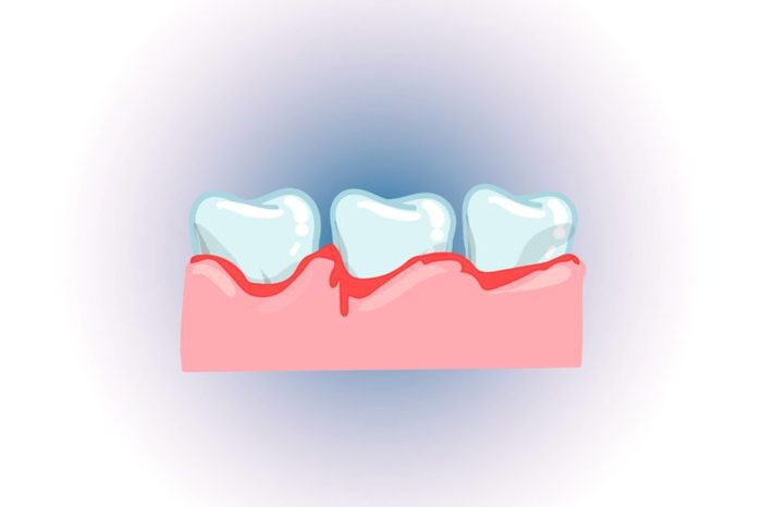 Illustration of three teeth bleeding in the gums, or an infection.