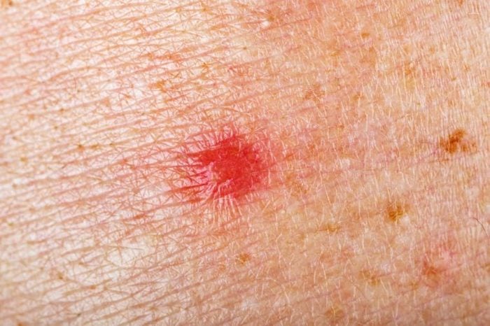 close up of red spot on skin