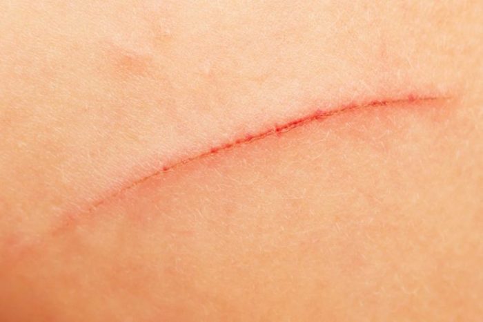 close up of a scar on skin