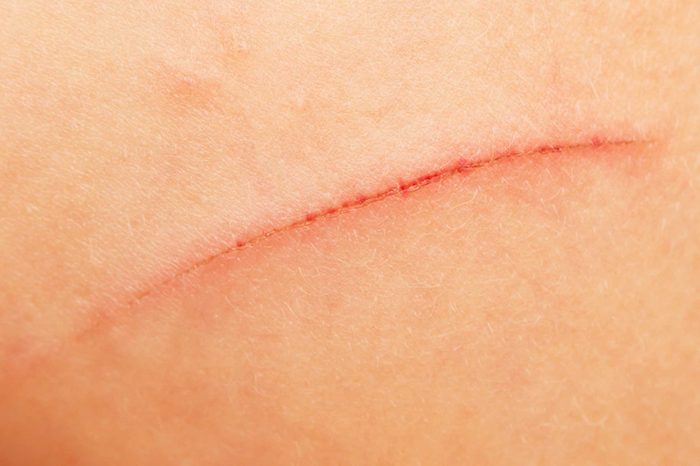 close up of a scar on skin