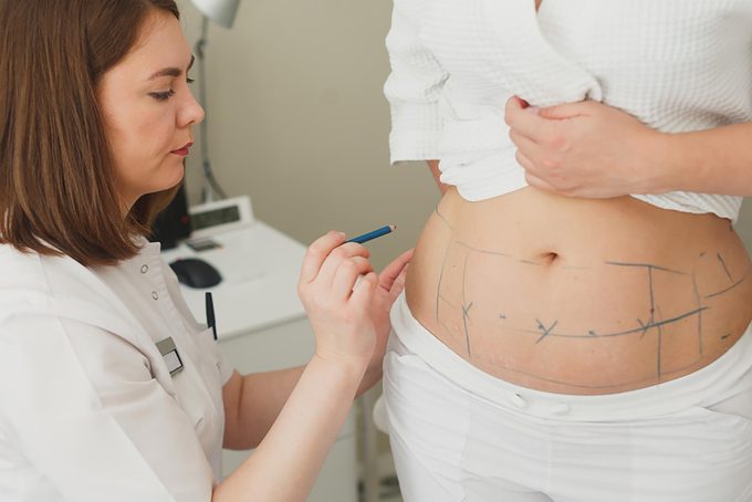 woman marking patient's abdomen for surgery