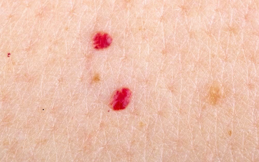 Flock forbruger sort How to Remove Cherry Angiomas (Red "Moles") | The Healthy