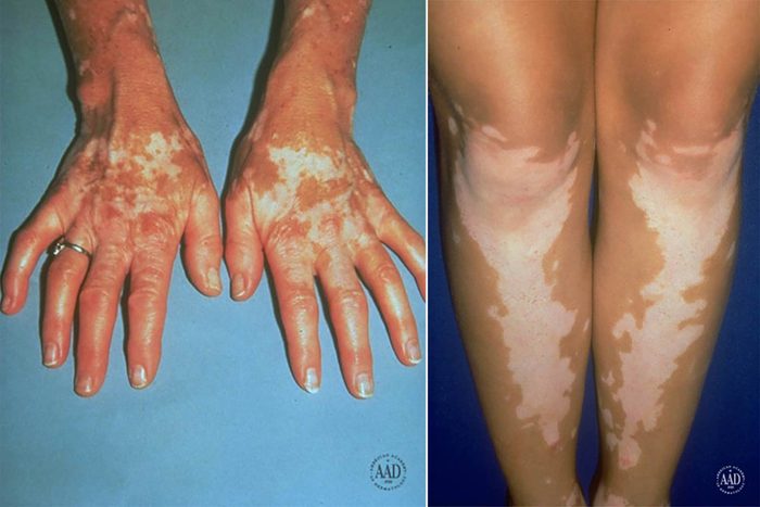 Vitiligo on the hands and lower legs