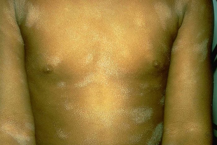 Pityriasis alba on the chest and arms