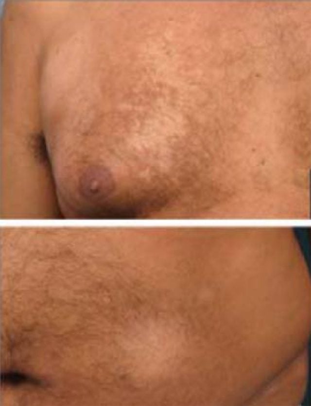 Hypopigmented mycosis fungoides on the chest and belly
