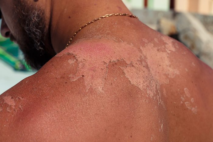 white spots on sunburned skin of a man's shoulders and back
