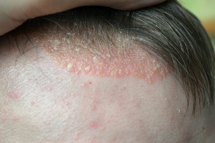 scalp with itchy looking eczema at hairline