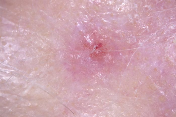 a closeup of amelanotic melanoma