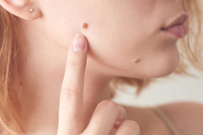 woman pointing to mole on her face
