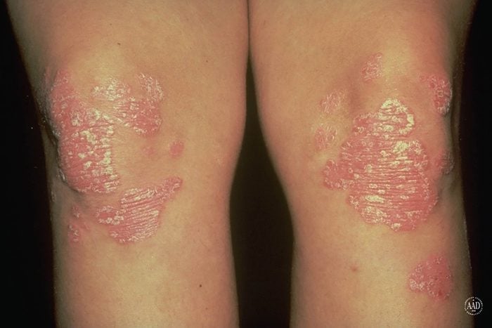 Psoriasis on the knees