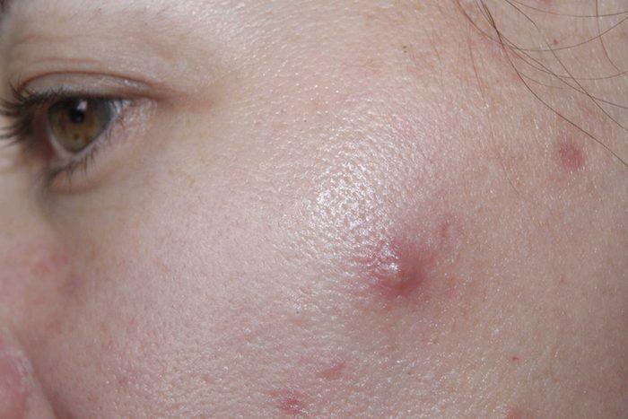 woman with cyst on her face