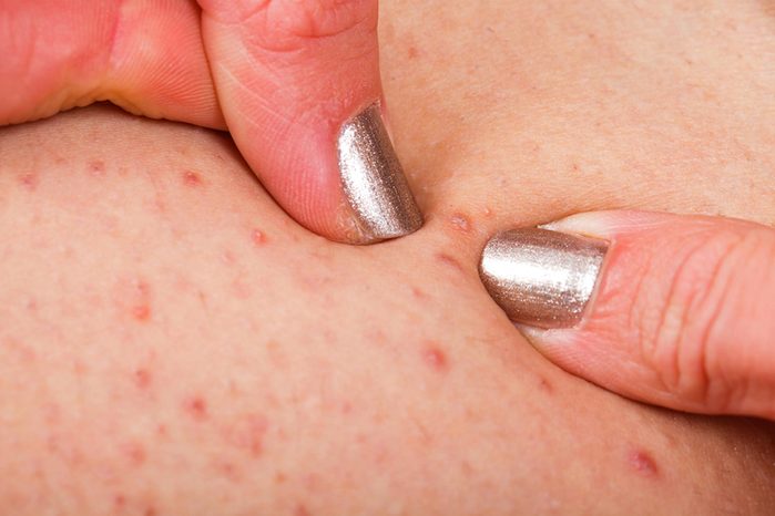 woman squeezing pimples on skin