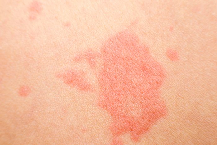 red patch on skin
