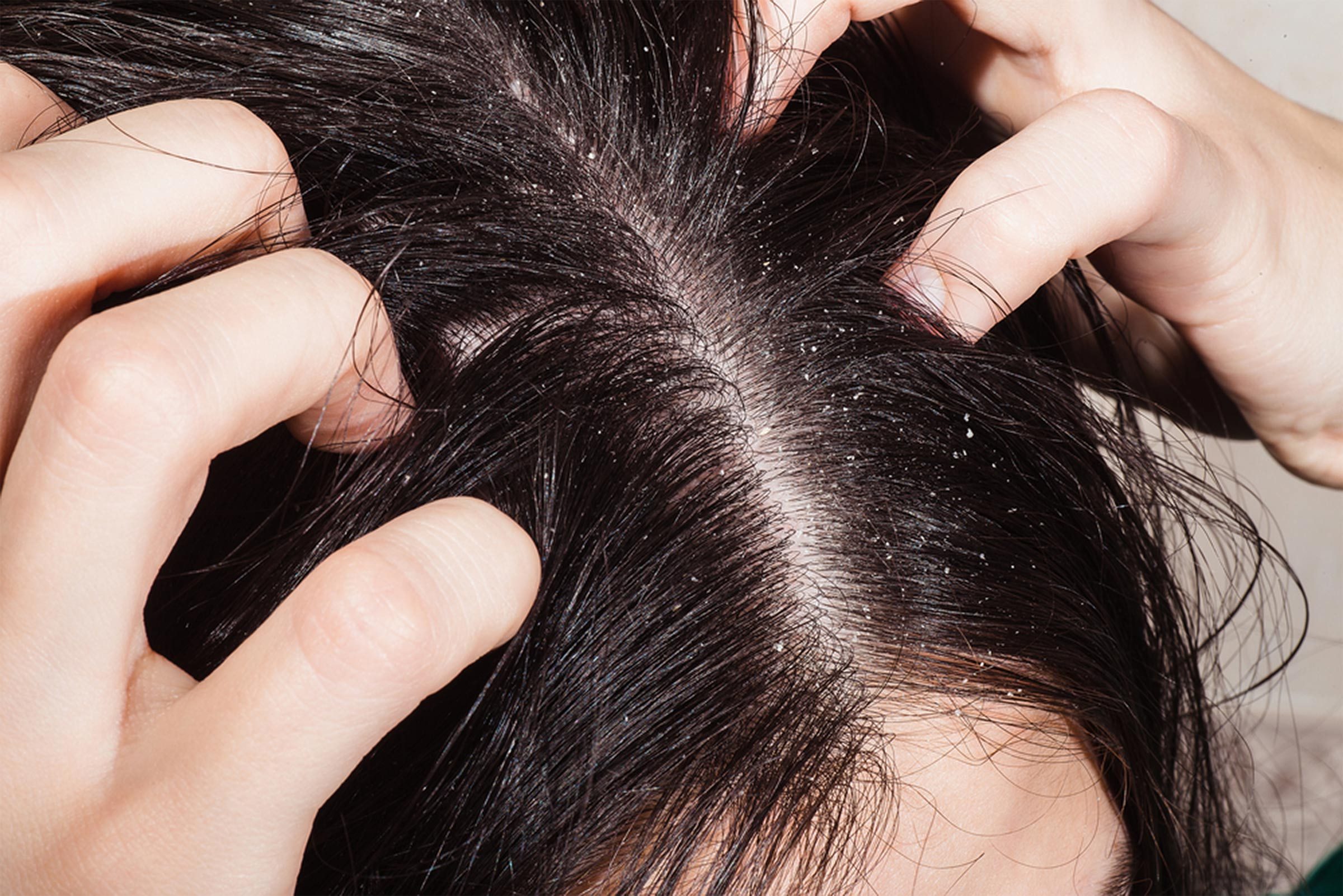 21 reasons for your itchy scalp (besides head lice) | the