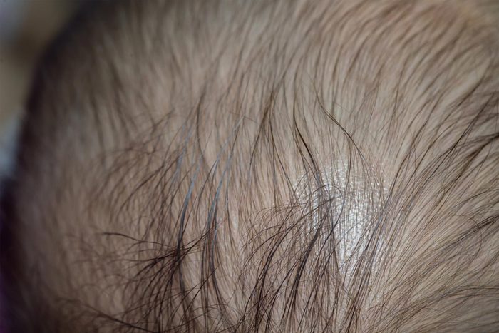 thinning hair on scalp