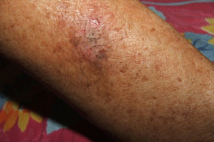 red lesions on skin