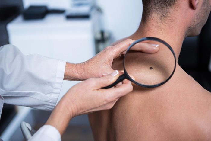 doctor examining mole on man's back