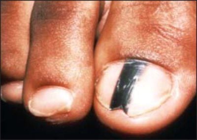 close up of a bit toe with a black stripe; nail melanoma