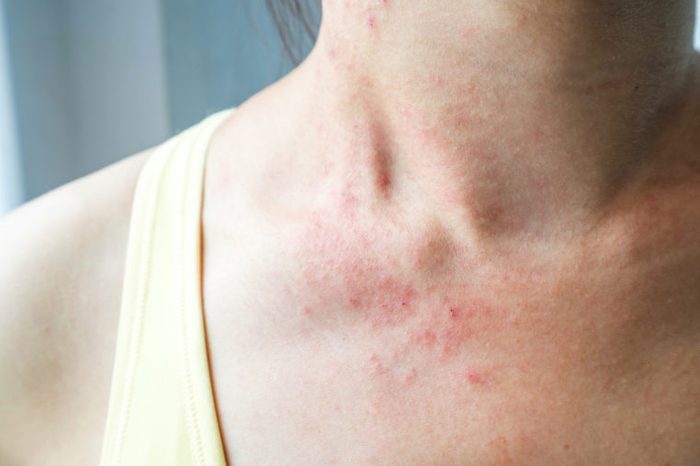 woman with rash irritated skin eczema