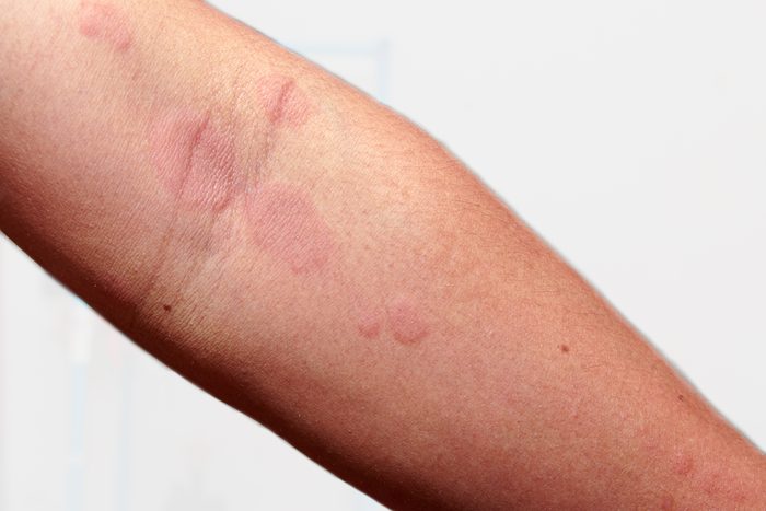 close up of arm rash spots skin irritation