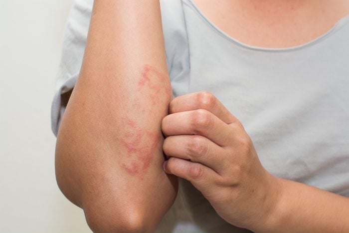 woman scratching itch arm skin rash