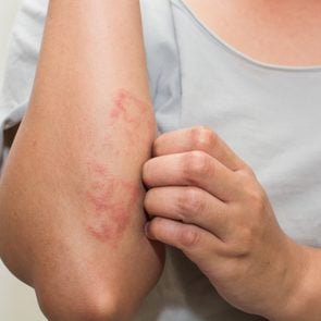 woman scratching itch arm skin rash