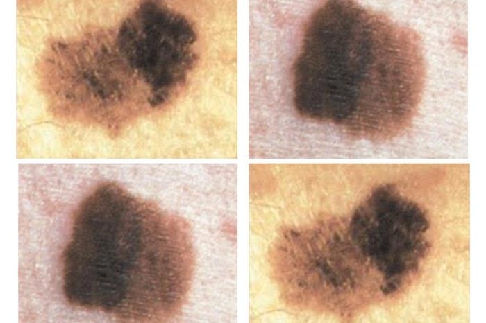Quad image of four brown spots on the skin.