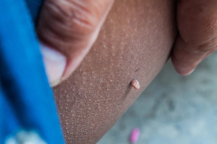 close up of a skin tag