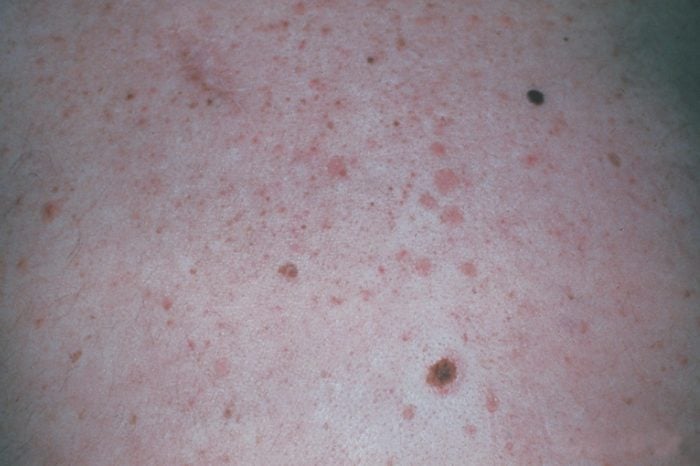 A person's skin that has a mole on it.