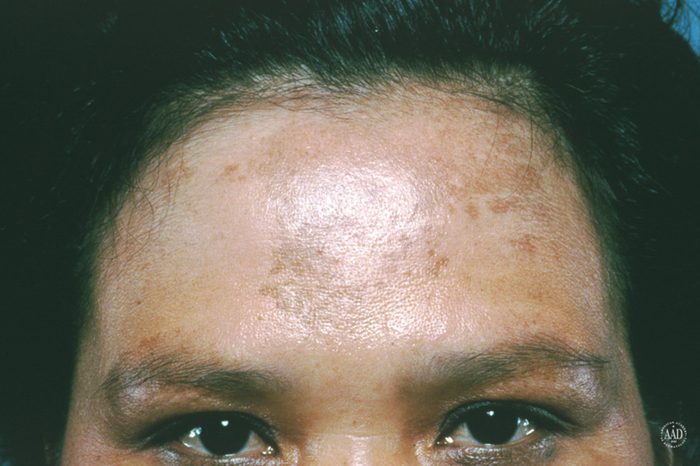 Woman's forehead that has melasma marks.