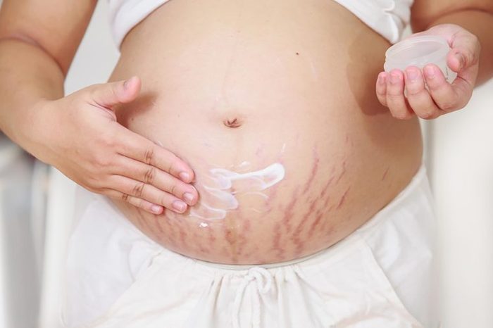woman rubbing cream into stretch marks on her pregnant belly