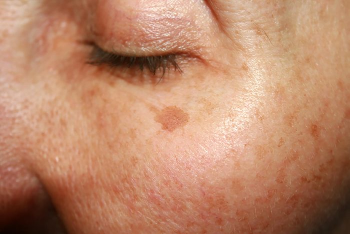 skin with melanoma under eye