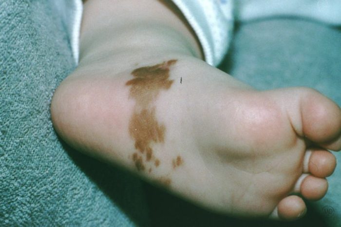 Child's foot that has a large brown birthmark on it.