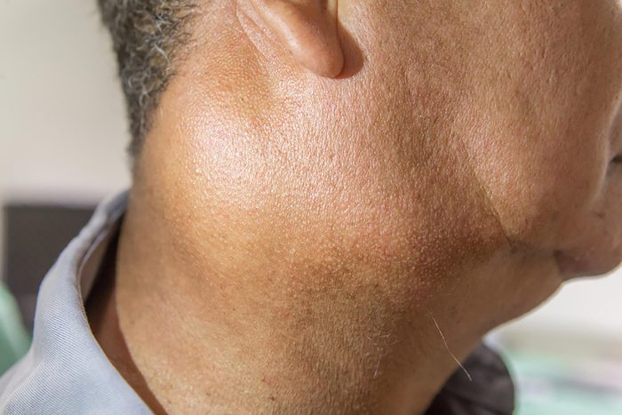 man with very swollen lymph nodes