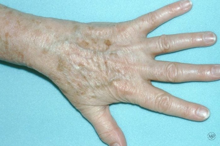 Older person's hand that has age spots on it.