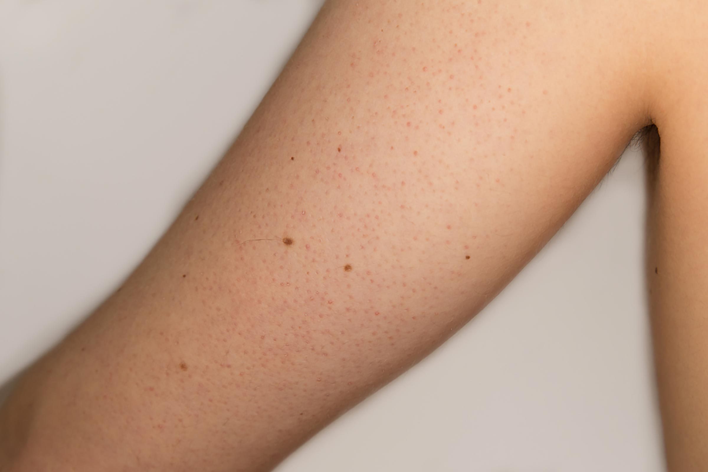 keratosis on the upper arm