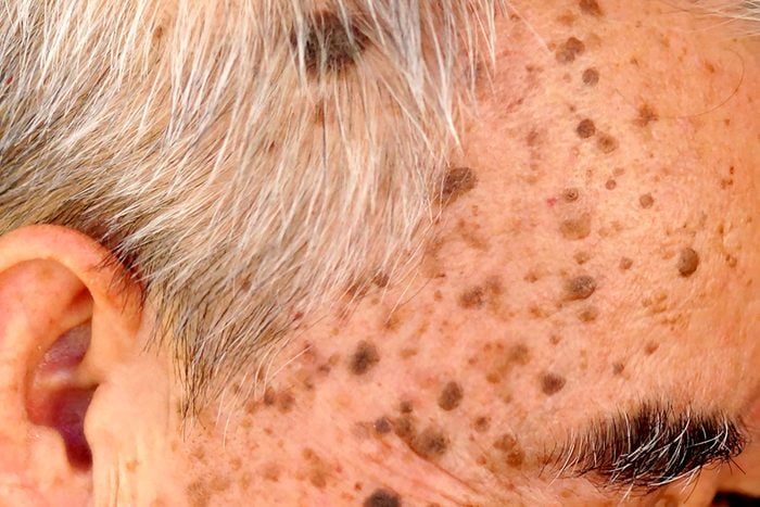 elderly man's face with seborrheic keratosis