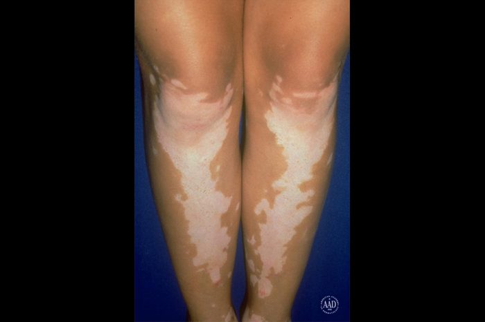 Pair of legs with white vitiligo marks on the knees and shins.