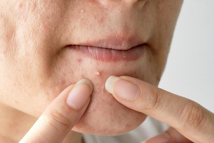 pimple on woman's chin