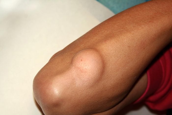 large lipoma on the forearm