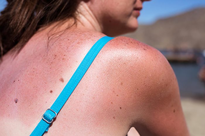 sunburn on woman's shoulder