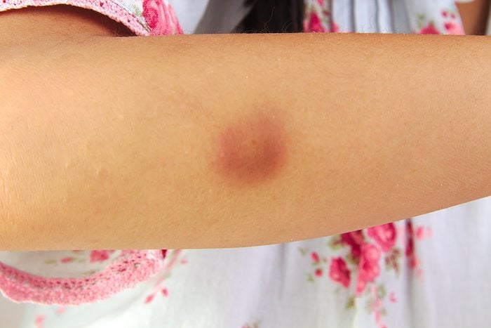 hematoma on a woman's upper arm