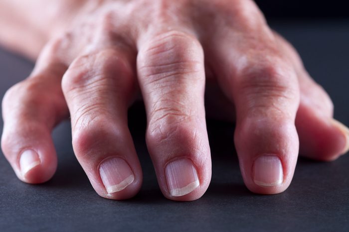 osteoarthritis in fingers